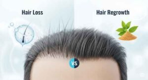 চুল পড়া সমাধান