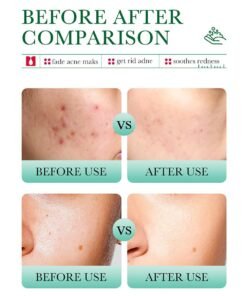 Alternative view of Bioaqua Salicylic Acid Acne Marks Removal Cleanser 100g